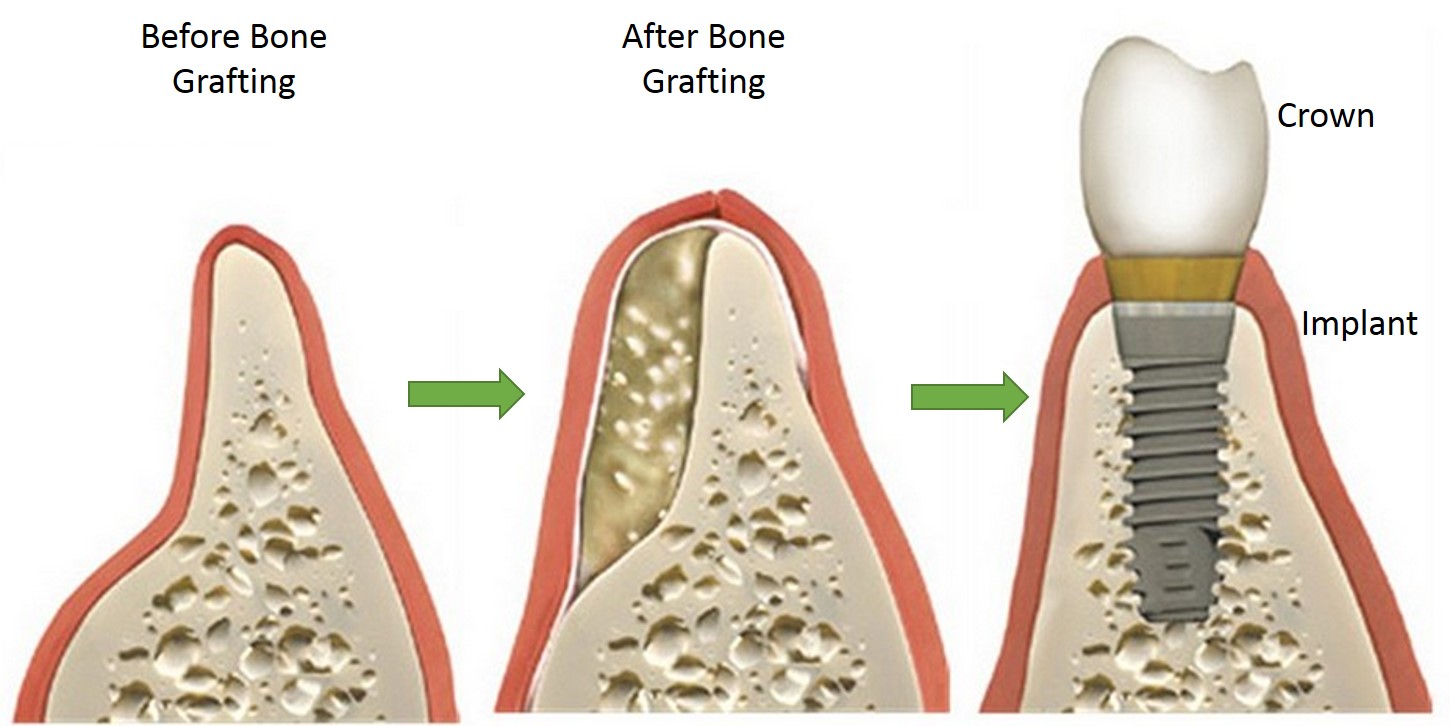 Bone grafting illustration