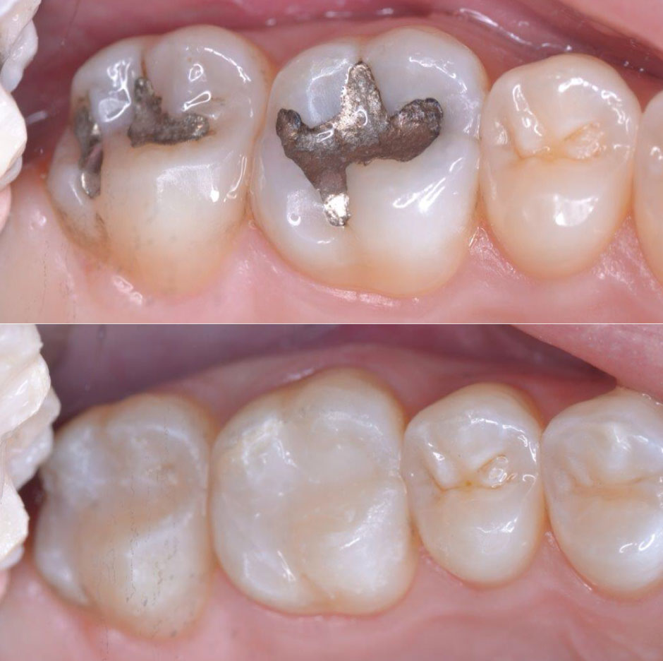 Composite Fillings - Ridgewood, NJ - Ridgewood Dental - Dental Filling