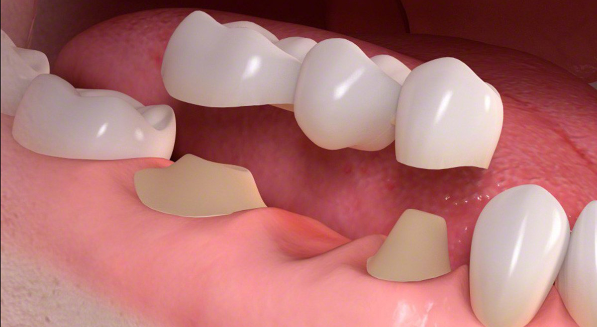 Dental Bridges illustration