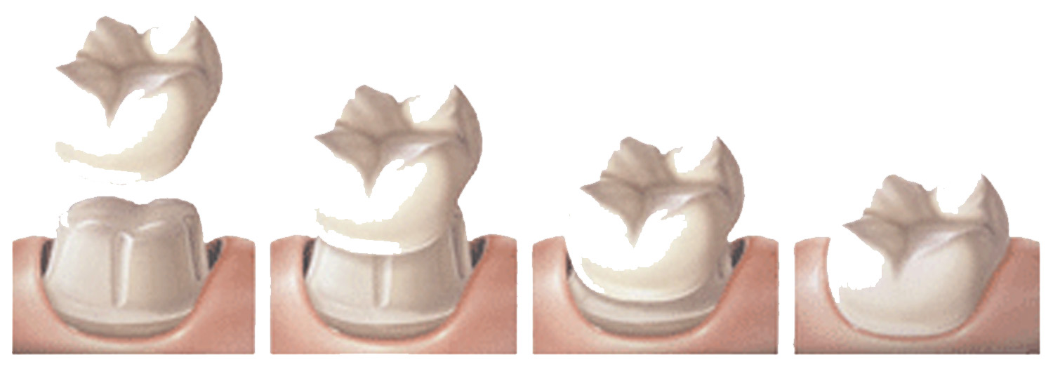Dental Crown illustration