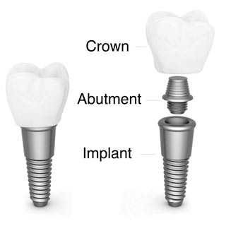 Dental Implant Breakdown