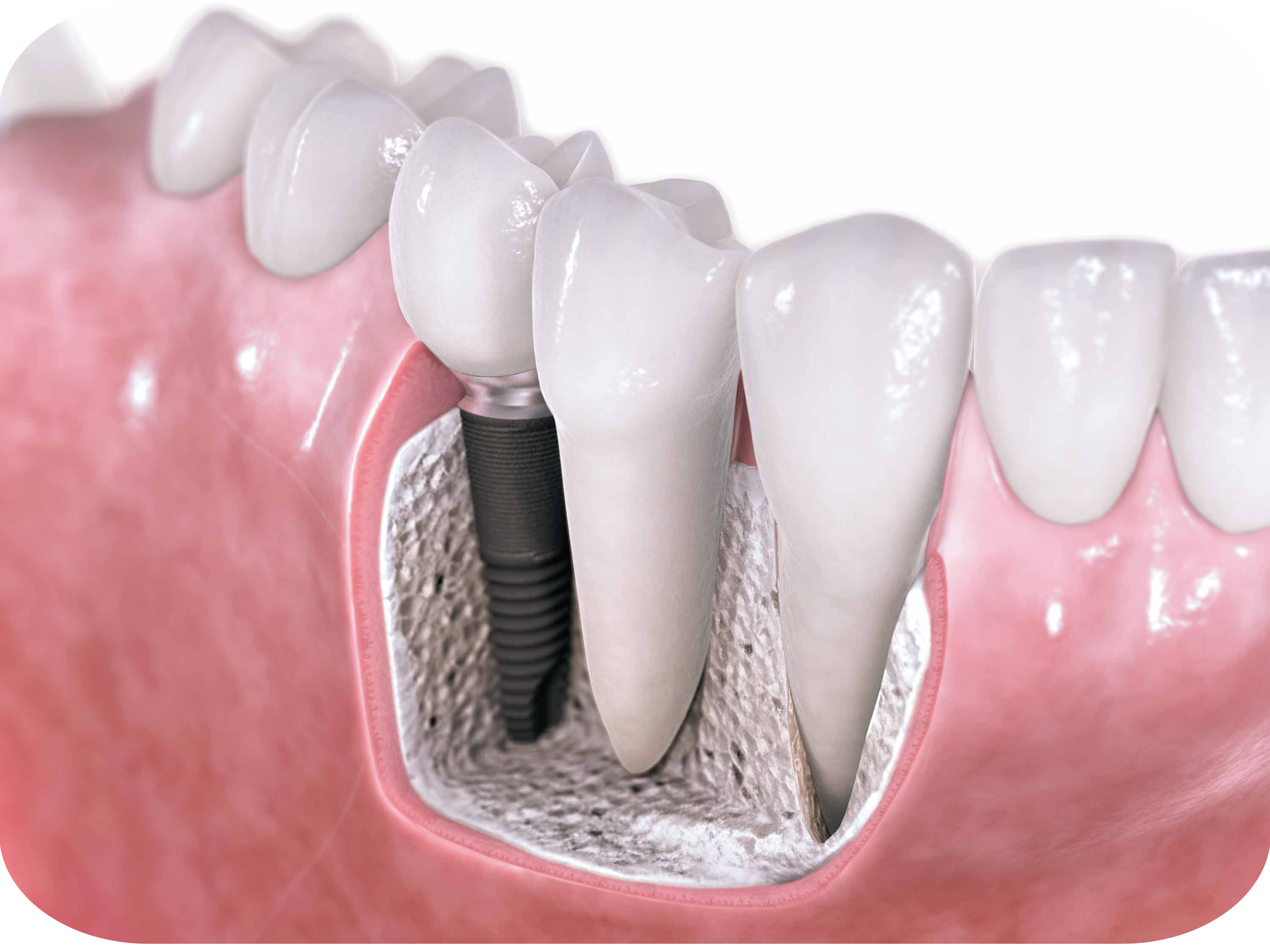 Dental Implant Illustration