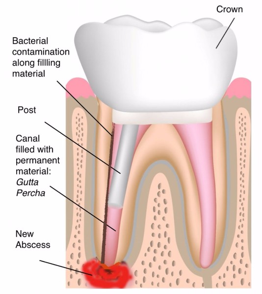 Endodontic Procedure