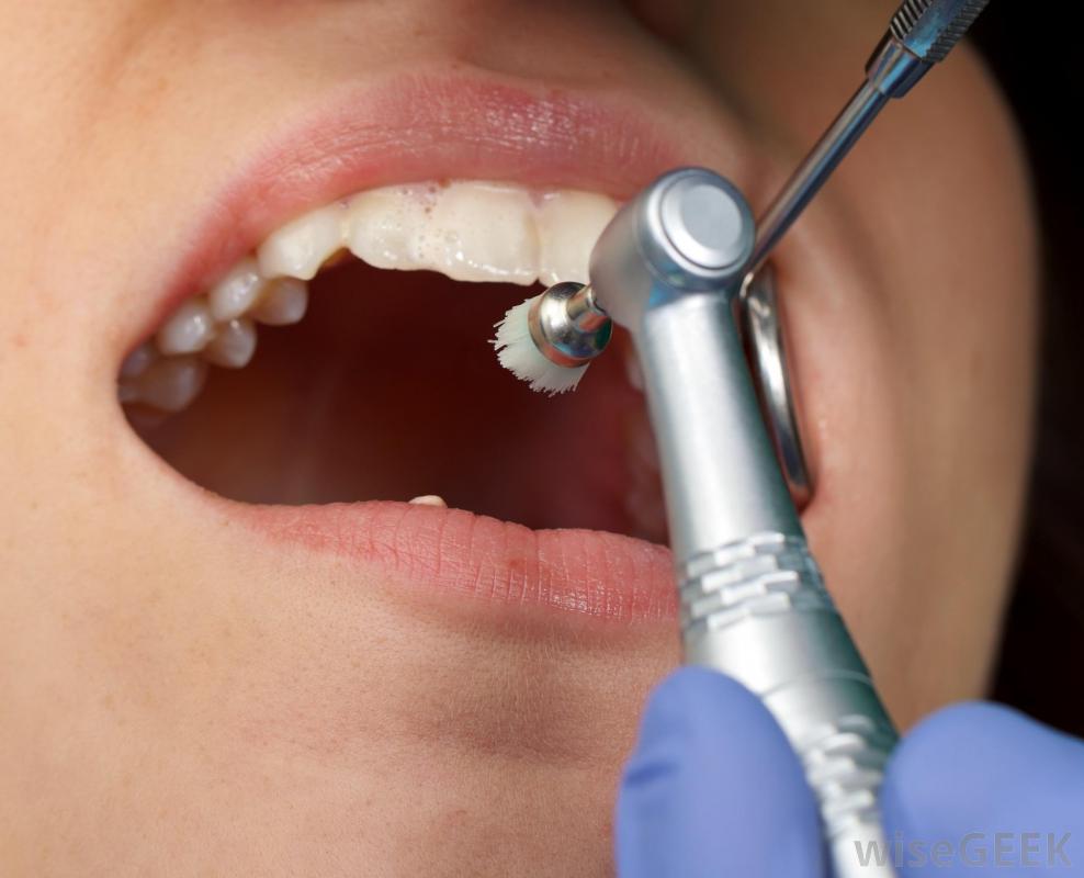 Fluoride Treatment Procedure