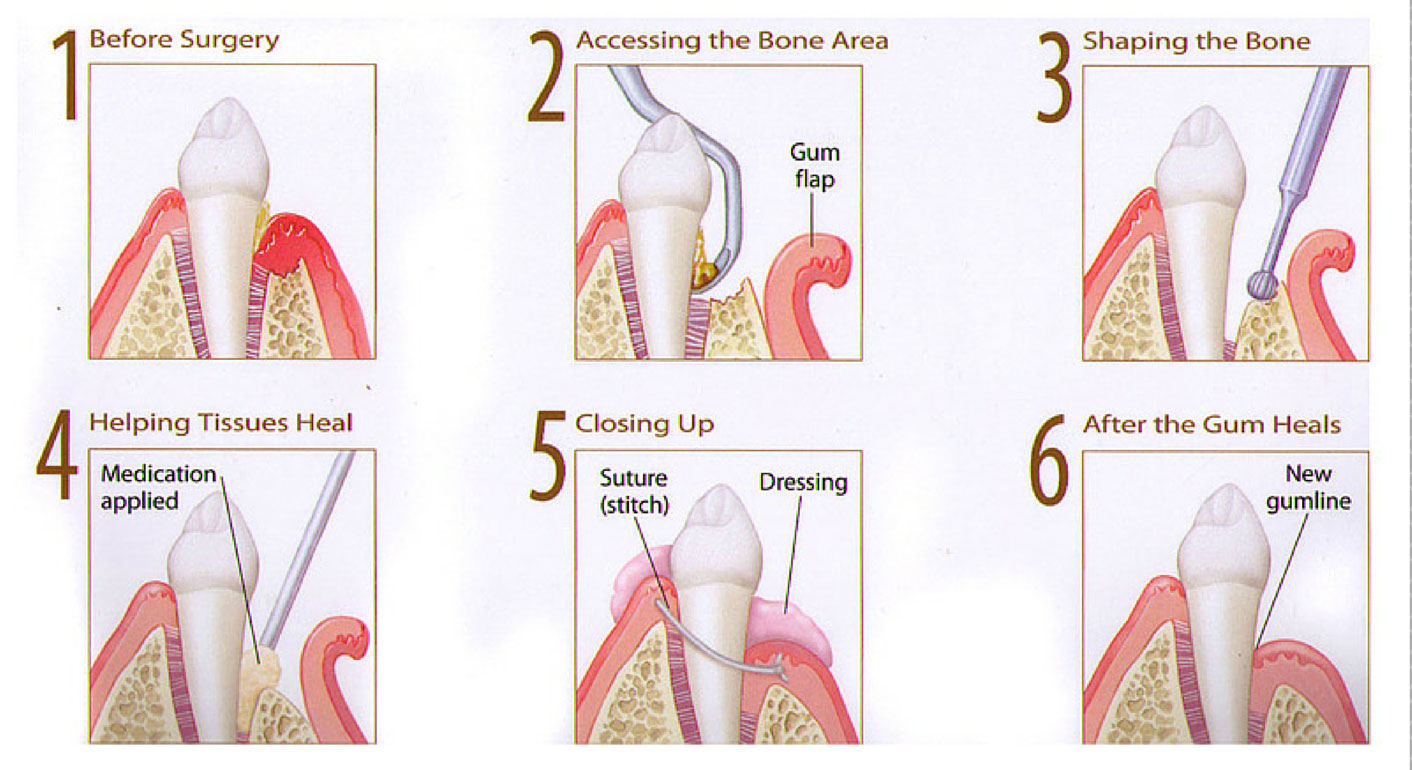 Gum Disease Treatment Illustration