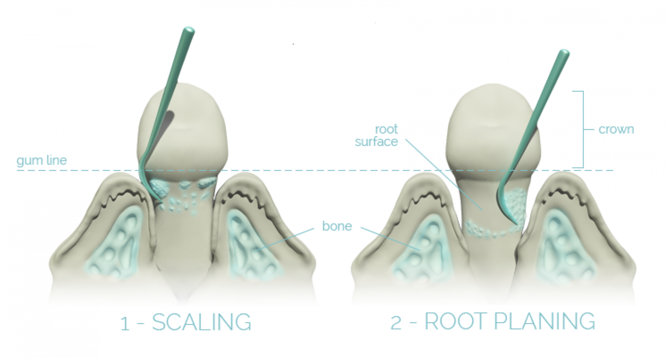 Gum disase procedure