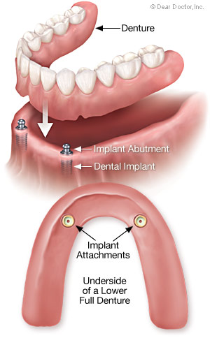 Implant Overdentures Illustration