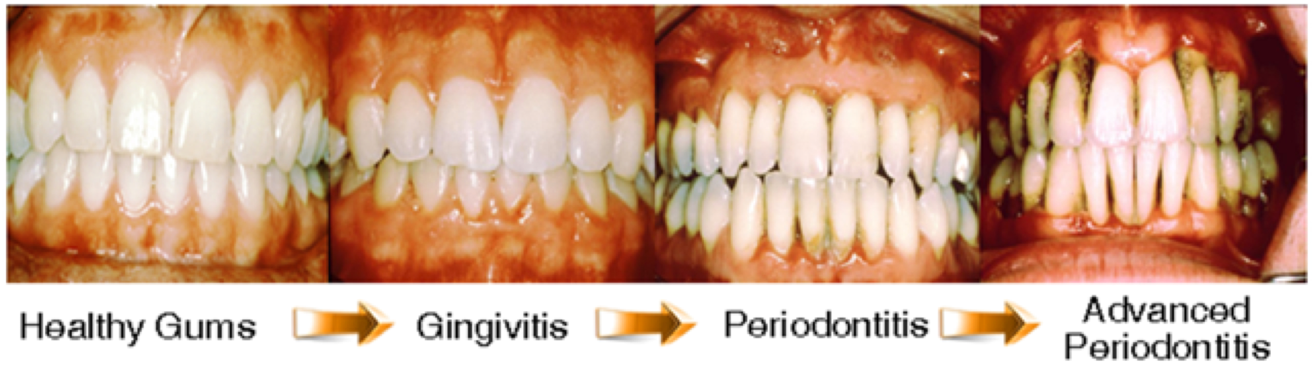 Periodontal Disease Illustration