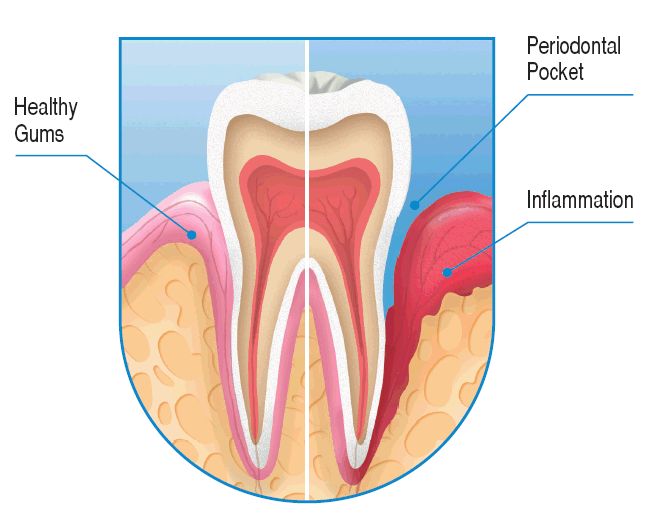 Deep Pockets in gums - Arudhra dental care