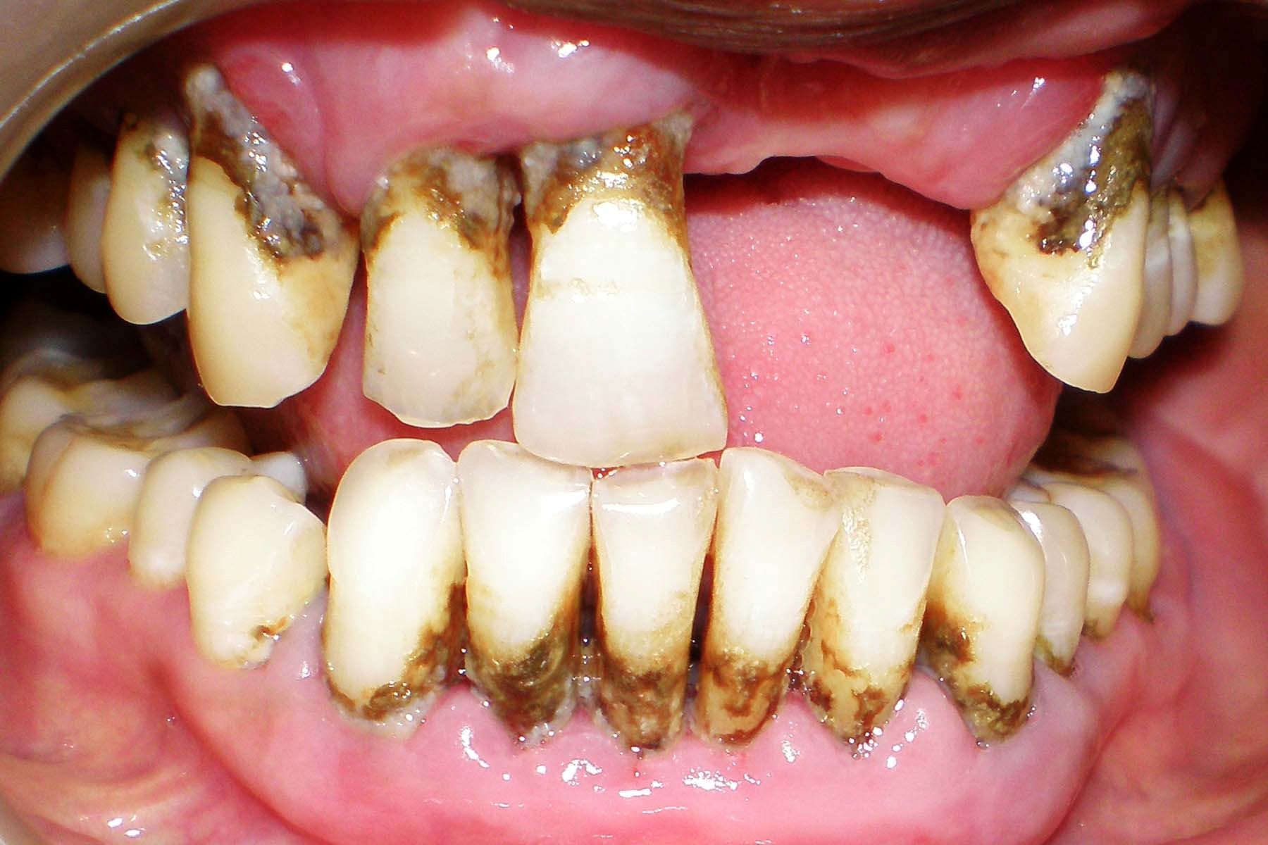 advanced periodontal disease